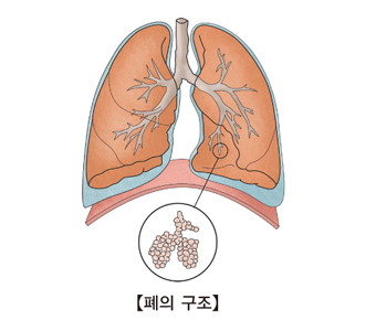 흉막삼출